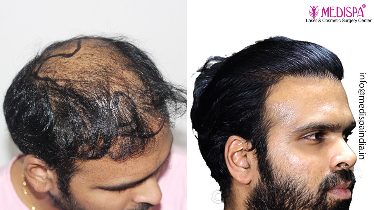 best hair transplant results after 12 months
