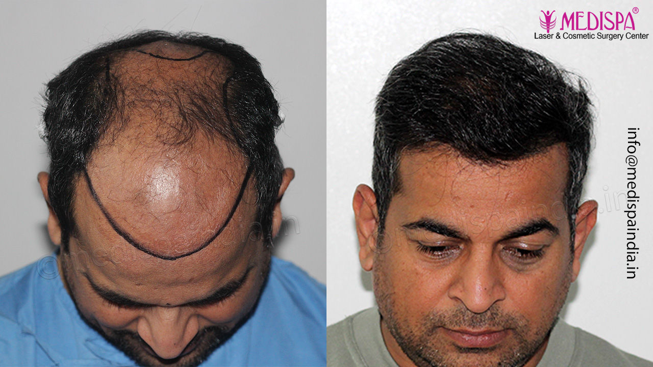 best hair transplant surgeon results bangalore