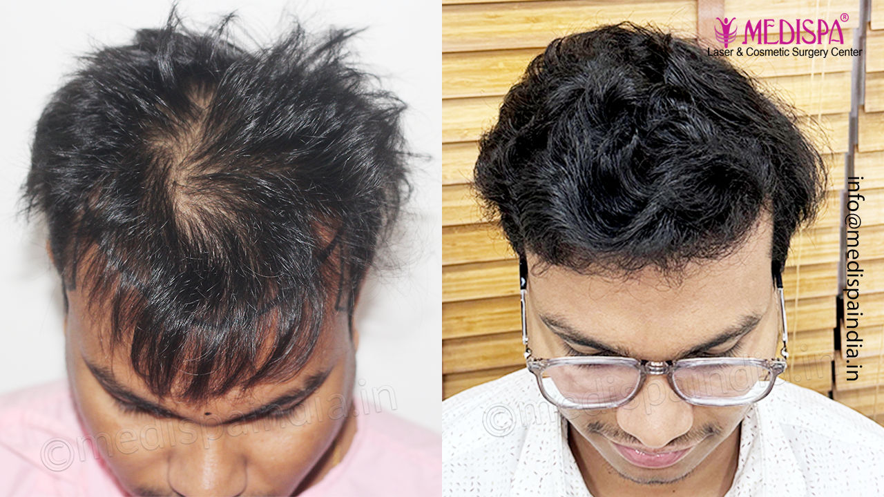 hair restoration india results
