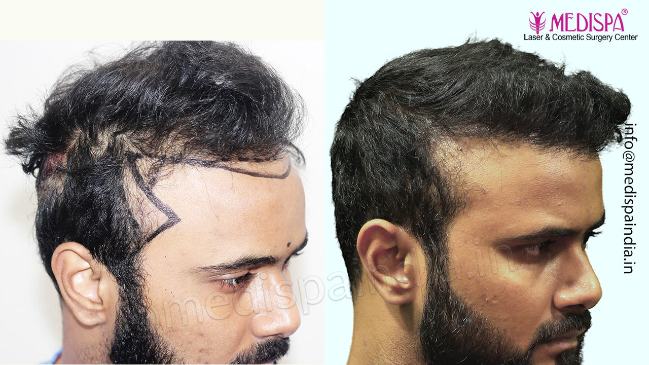 hair transplant delhi results