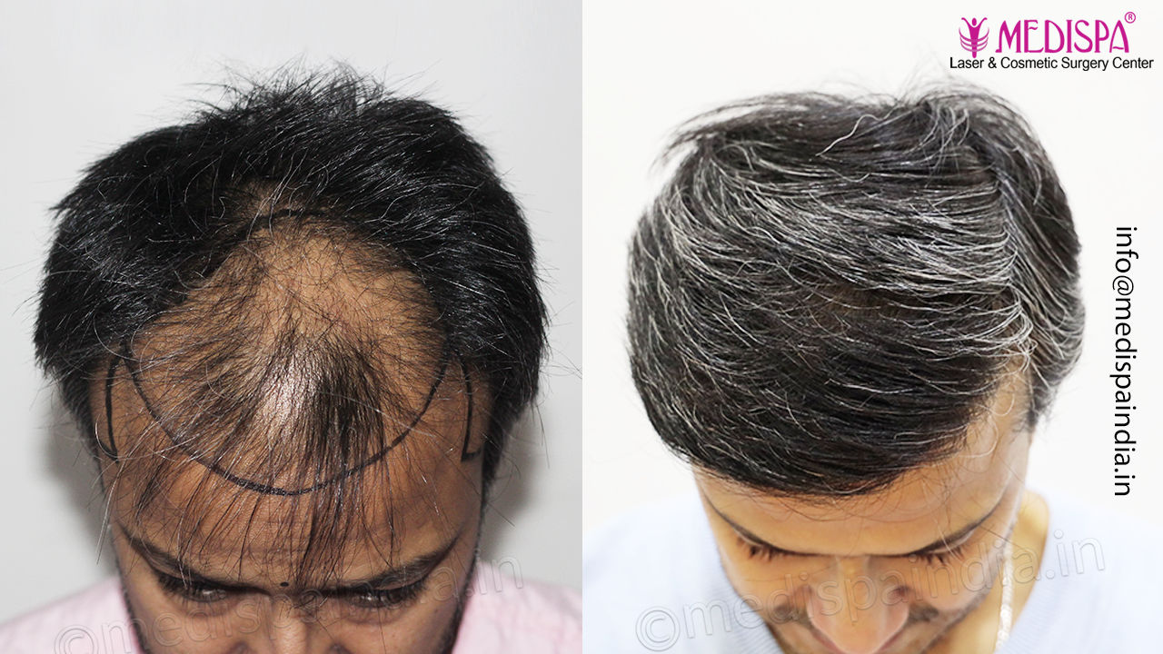 hair transplant india