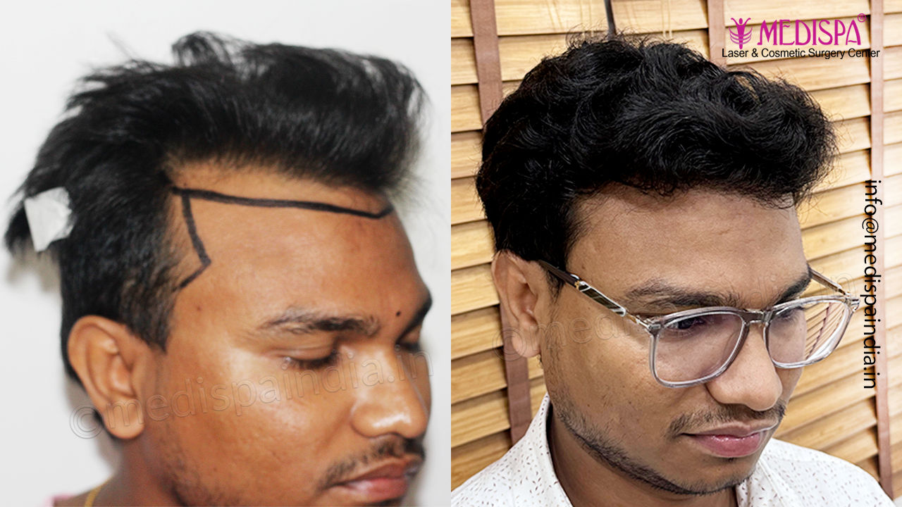 hair transplant india result