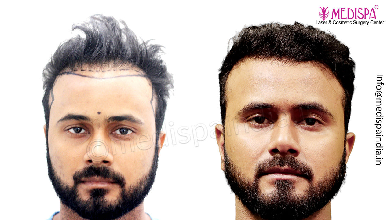Jaipur hair transplant result