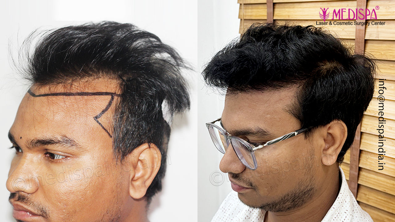 hair transplant india results