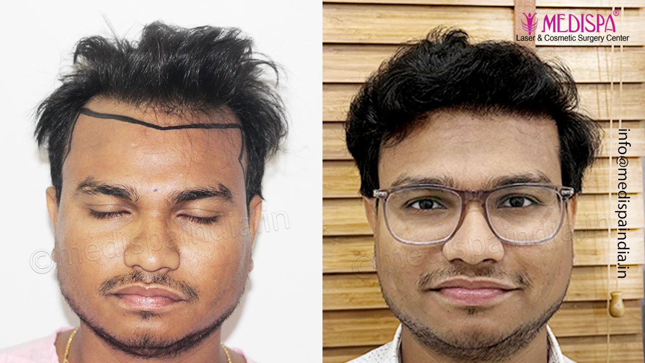 hair transplant india