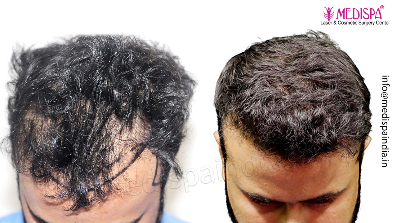 hair transplant jaipur india results