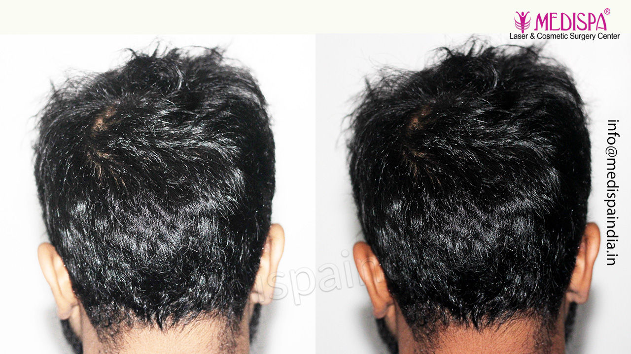 hair transplant mumbai india results