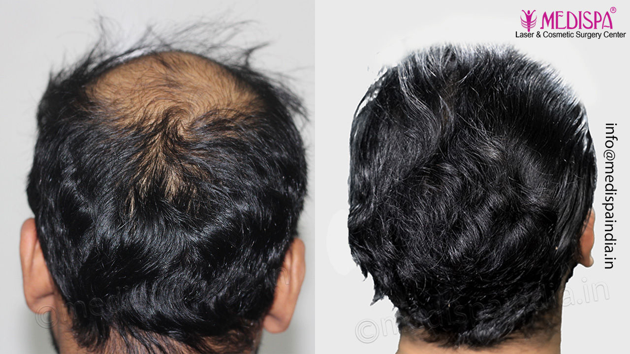 hair transplant result after 12 months
