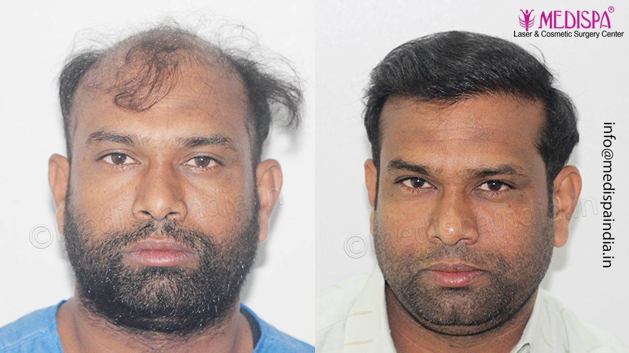 Bangalore hair transplant result
