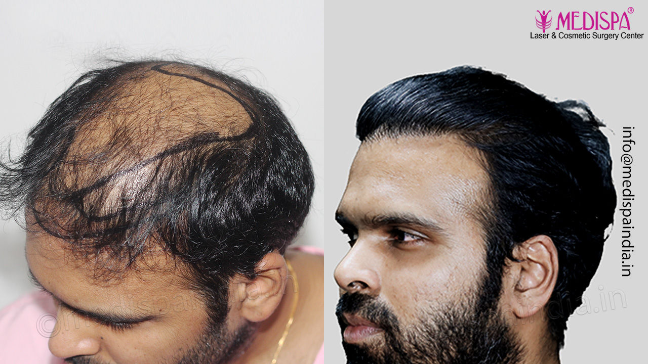 hair transplant results after 1 year