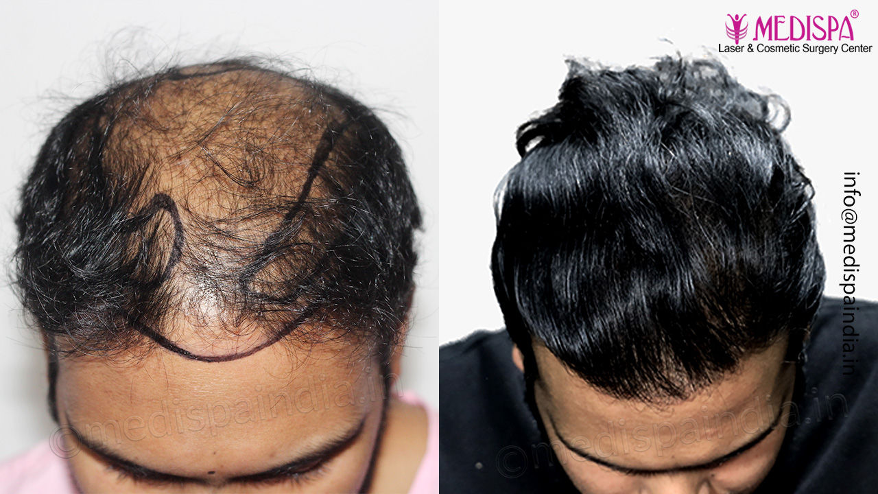 hair transplant results after 10 months