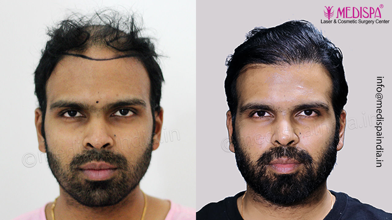 Bangalore hair transplant result