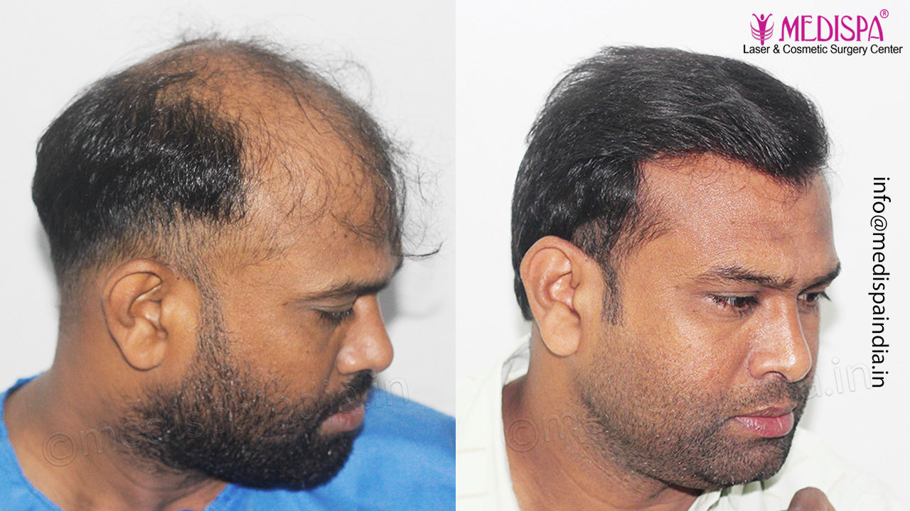 hair transplant results bangalore