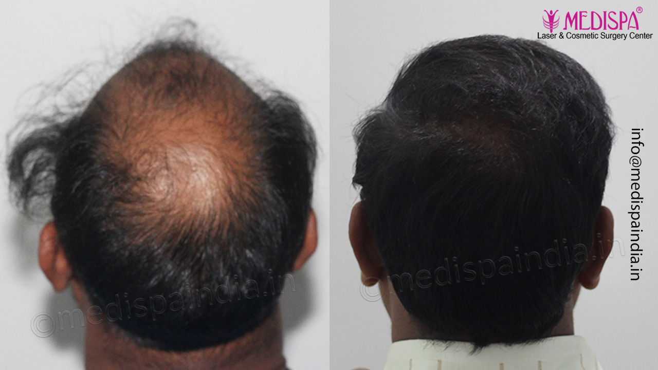 hair transplant results bangalore