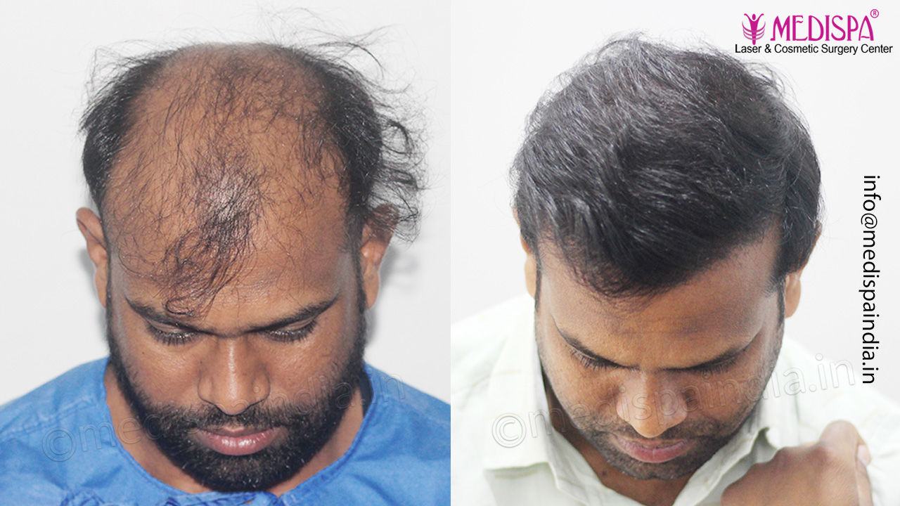 hair transplant results bangalore