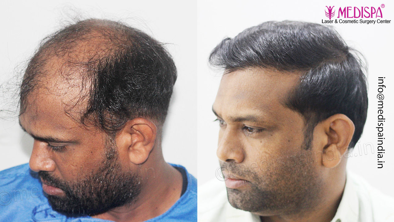 hair transplant results bangalore