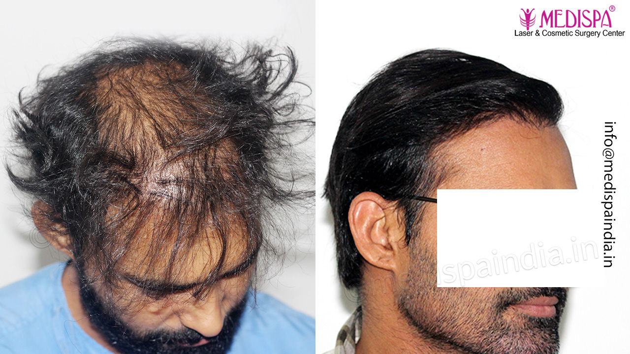 wrong hair transplant correction india