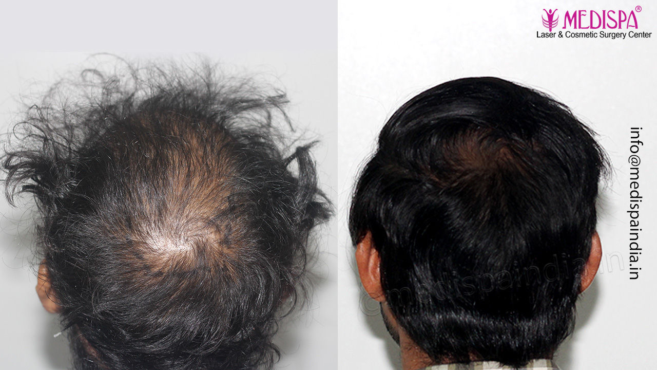 wrong hair transplant repair delhi