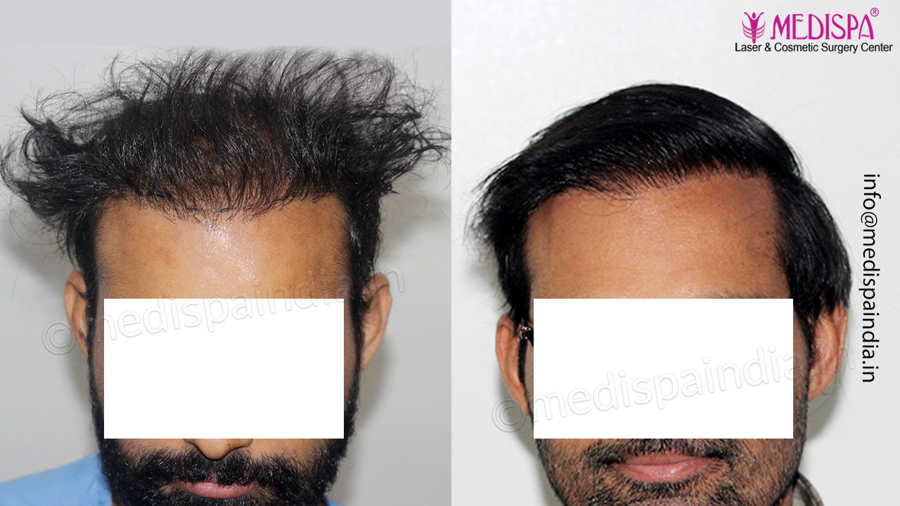 Gurgaon hair transplant result