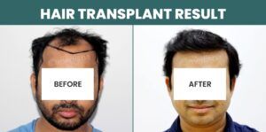 Hair Transplant Success: What Are The Chances Of Achieving Your Desired Results?