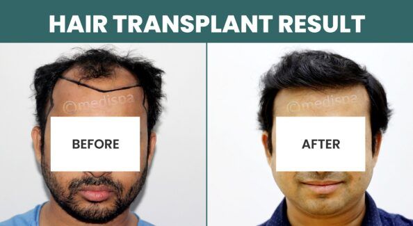 Hair Transplant Success: What Are The Chances Of Achieving Your Desired Results?