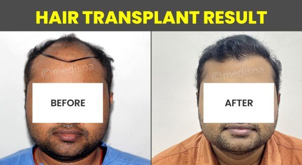 Creating A Seamless Hairline: Techniques For Natural-Looking Hair Transplant