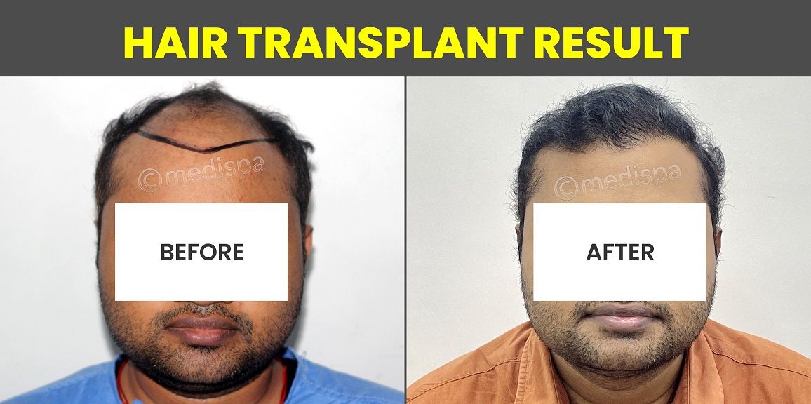 Creating A Seamless Hairline: Techniques For Natural-Looking Hair Transplant