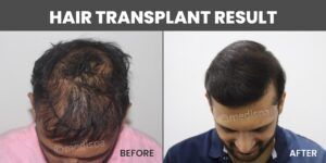 Hair Transplant: A Permanent Solution to Hair Loss