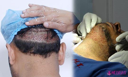 The High Cost of a Cheap Hair Transplant: Learning from the Kanpur Incident