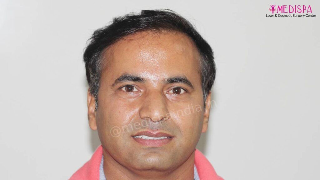 hair restoration india