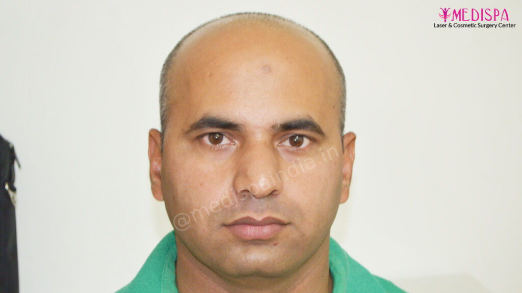 hair transplant india