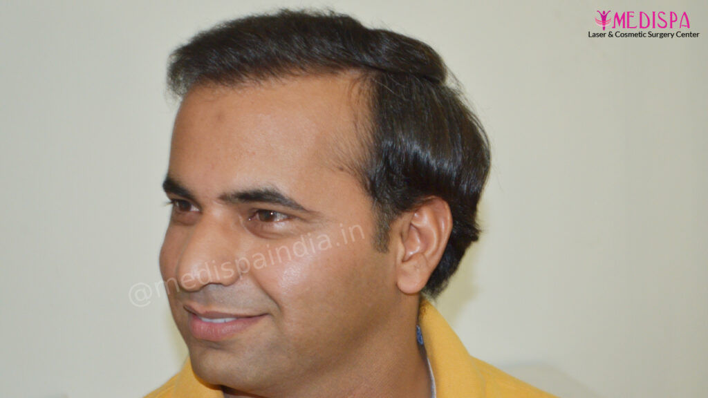 hair transplant jaipur