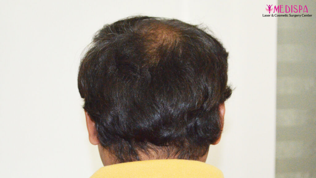 hair transplant jaipur