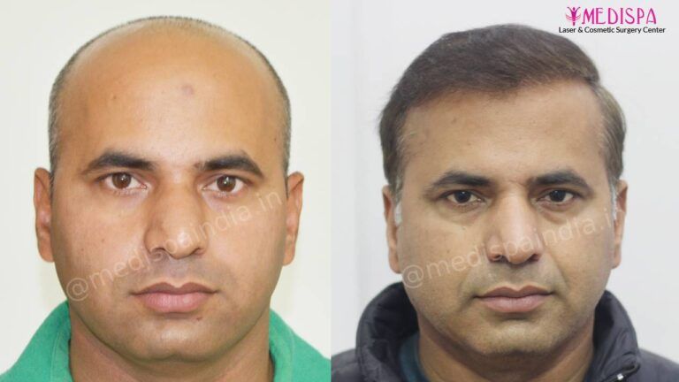  hair transplant India