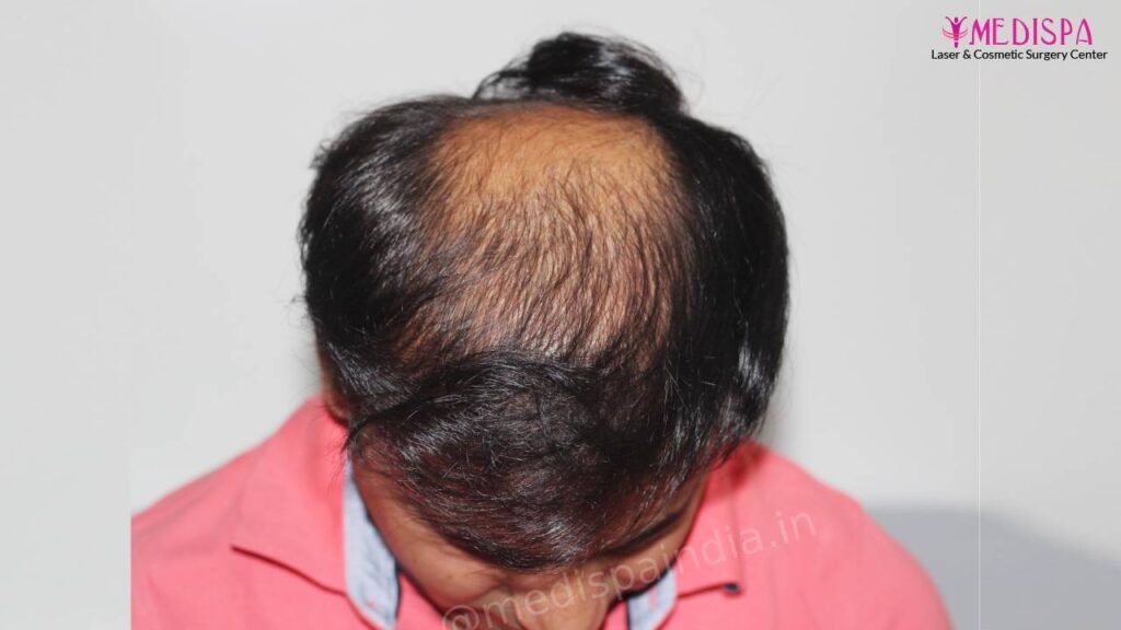 hair restoration india