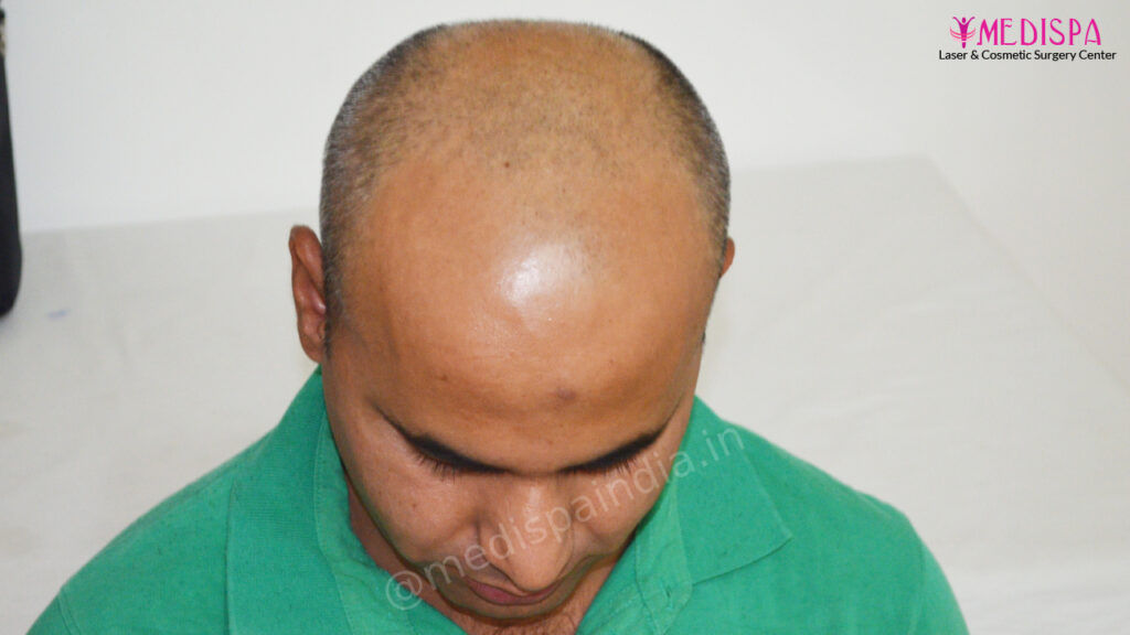 hair transplant india