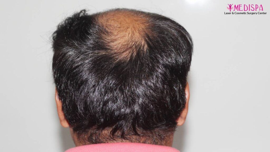 hair restoration india