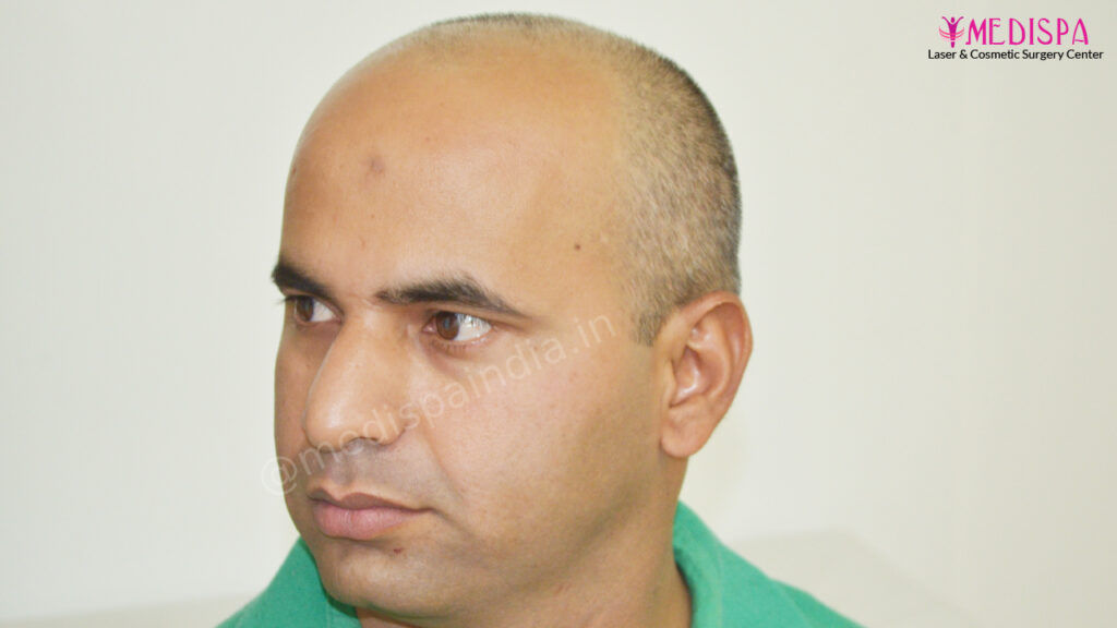 hair transplant india