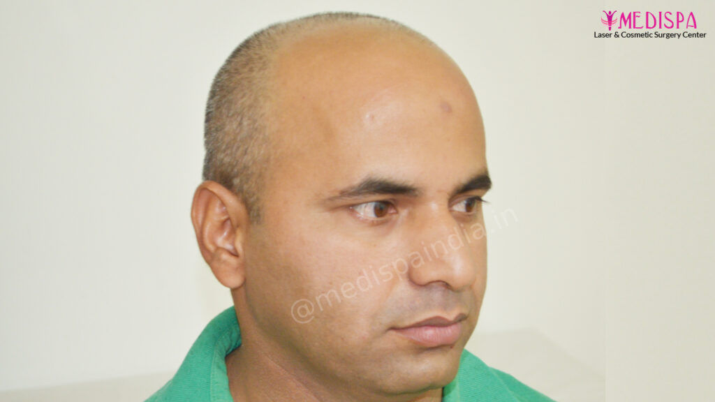 hair transplant delhi