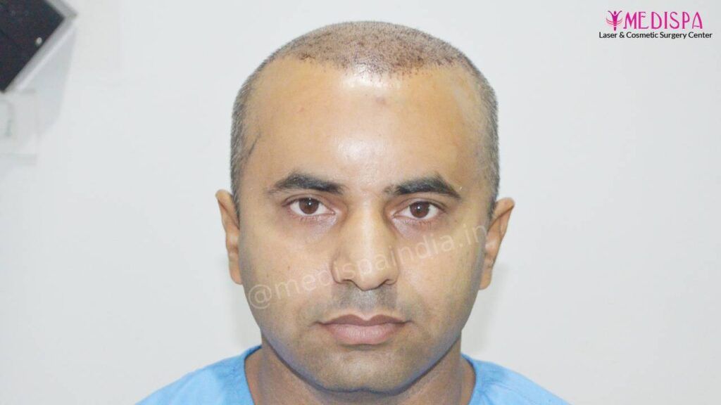 hair transplant delhi