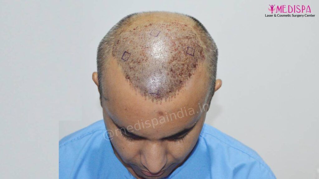 hair transplant delhi