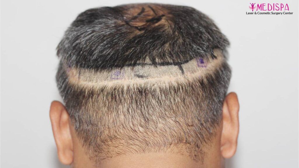 hair restoration india