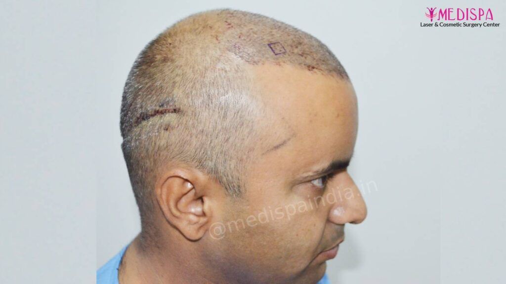 hair transplant jaipur