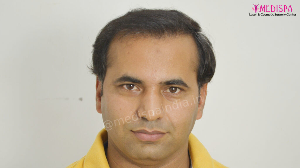 hair transplant jaipur