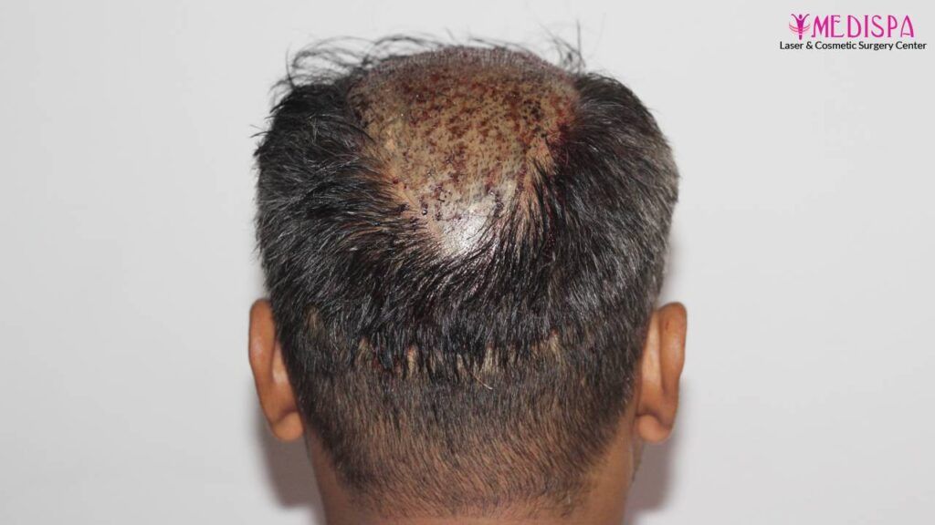 hair restoration india