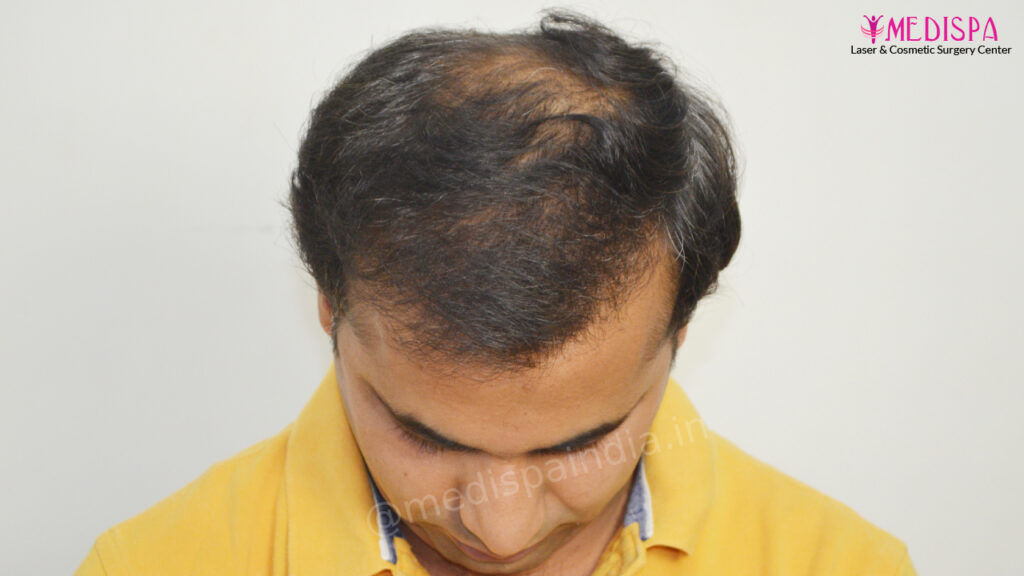 hair transplant jaipur