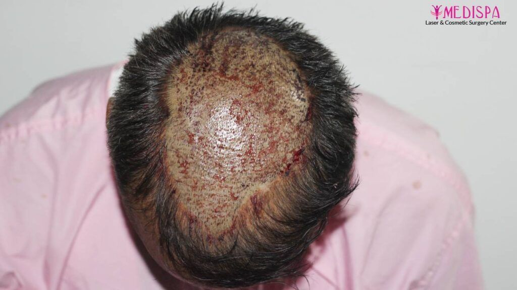 hair restoration india