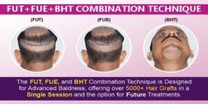 How is FUE+FUT+BHT Combination Hair Transplant Better Than Other Techniques?