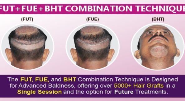 How is FUE+FUT+BHT Combination Hair Transplant Better Than Other Techniques?