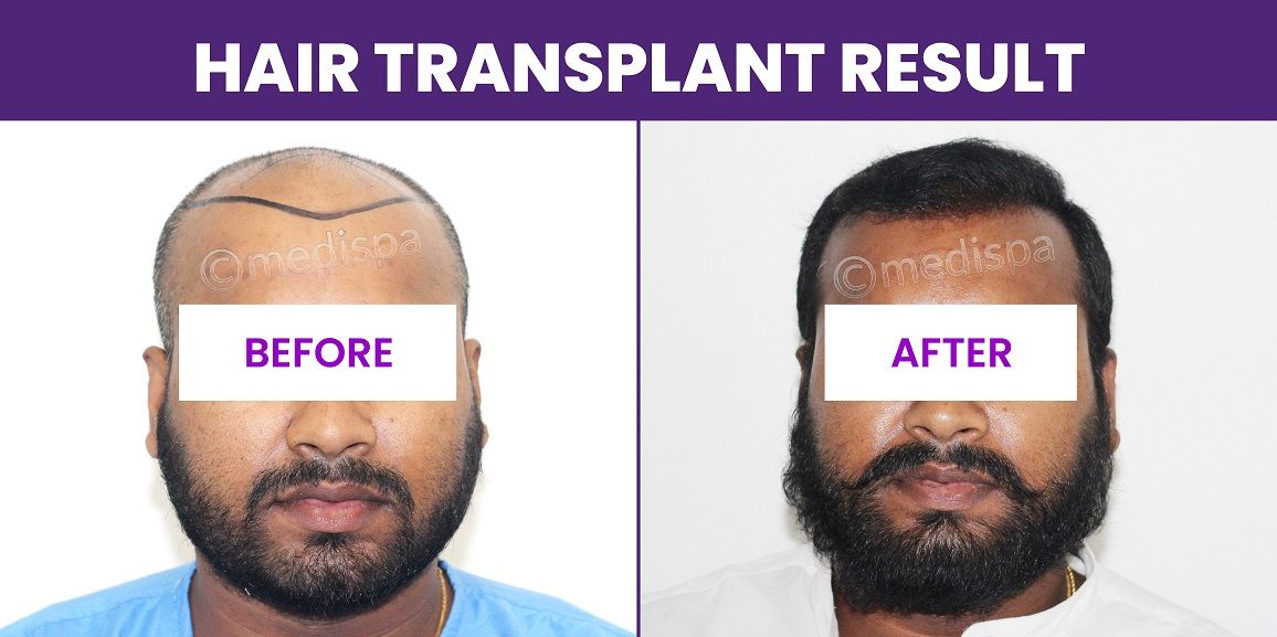 Is Hair Transplant The Best Option For Hair Re-growth?